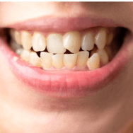 Crooked or misaligned teeth