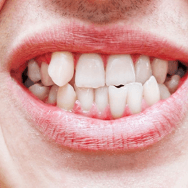 Crooked or misaligned teeth