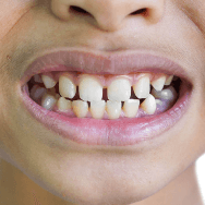 Gaps between teeth