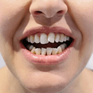 Misshaped teeth appearance