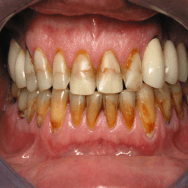 Stained and discoloured teeth