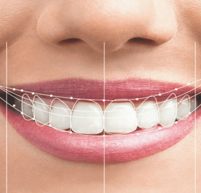 Smile makeover