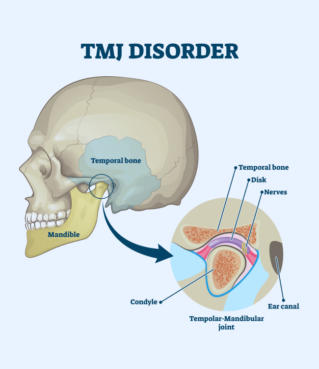 TMJ Treatment